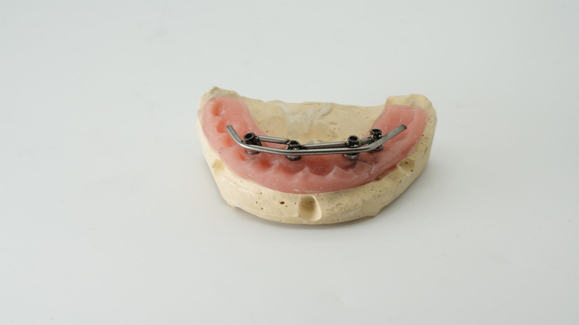 Macro detail of immediate-load prosthetics with a second titanium bar welded to the abutments
