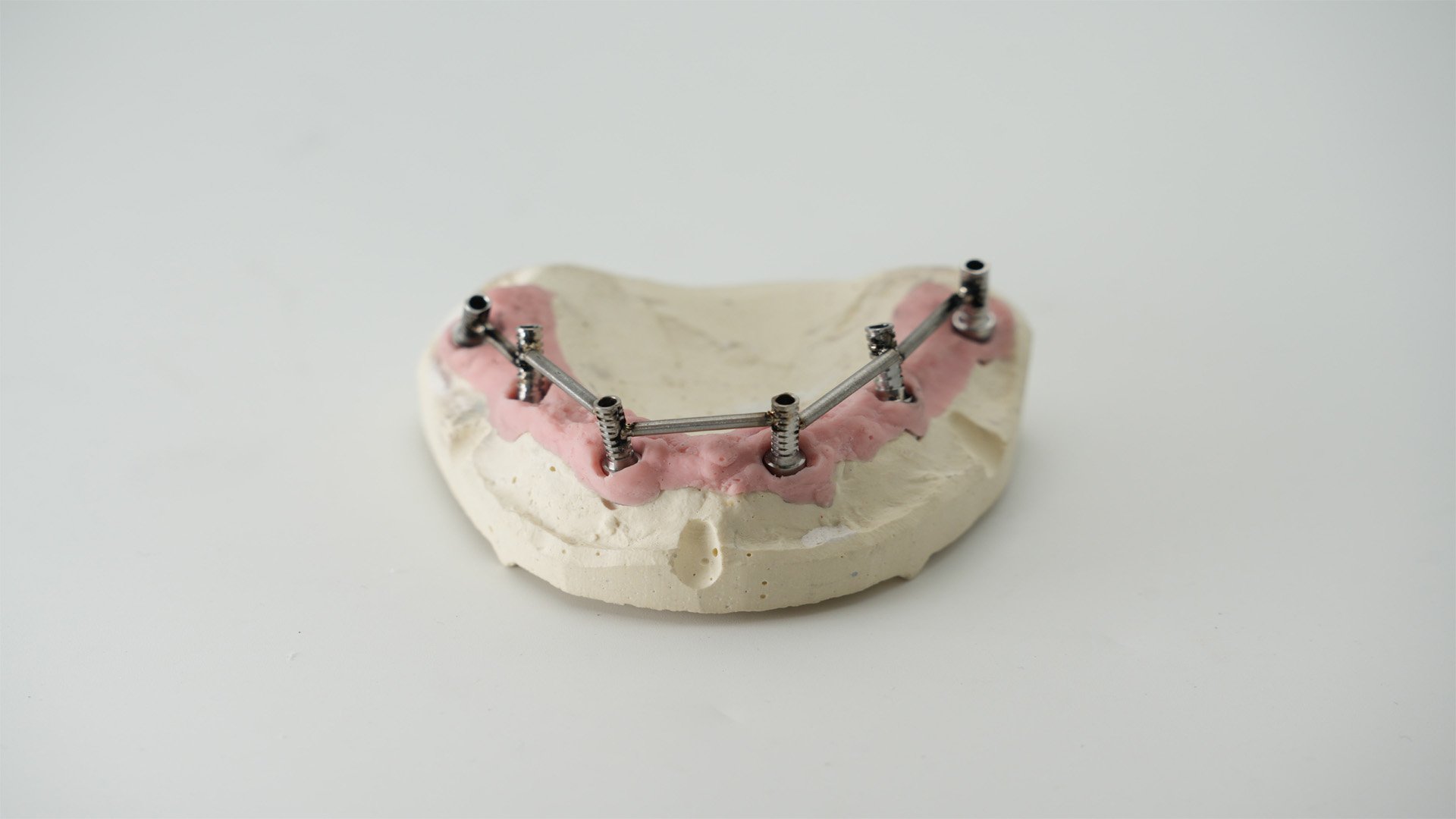 Dettaglio macro di una protesi a carico immediato con barre in titanio saldate alle torrette